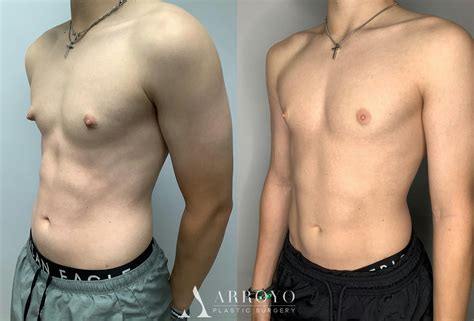 Gynecomastia .